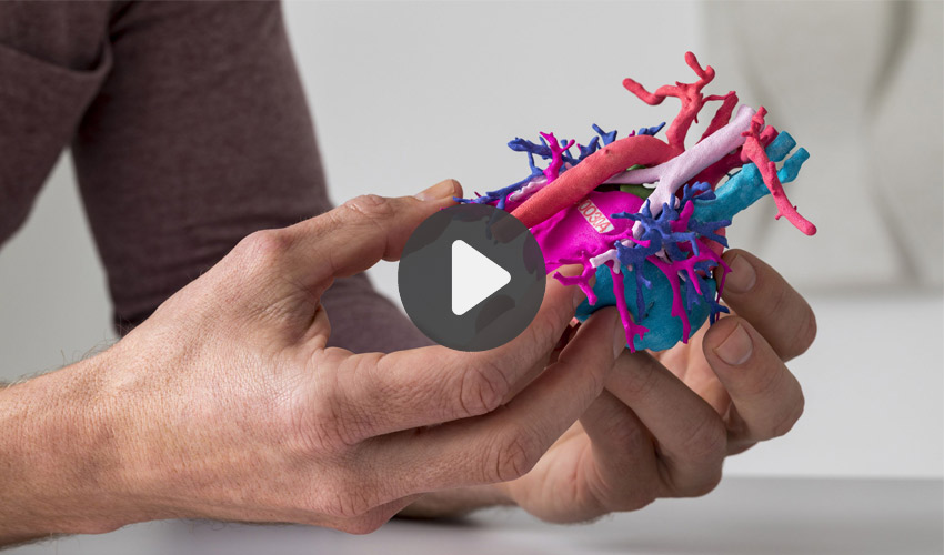 TOP 5 VIDEOS: 3D printing medical models to prepare for surgery…