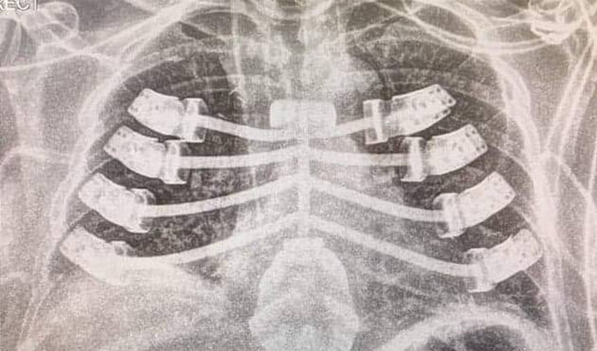Patient receives a 3D printed rib cage implant
