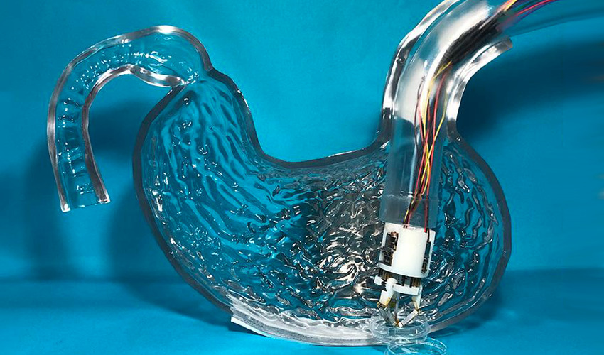 Bioprinting inside the body for a more effective treatment of stomach ulcers