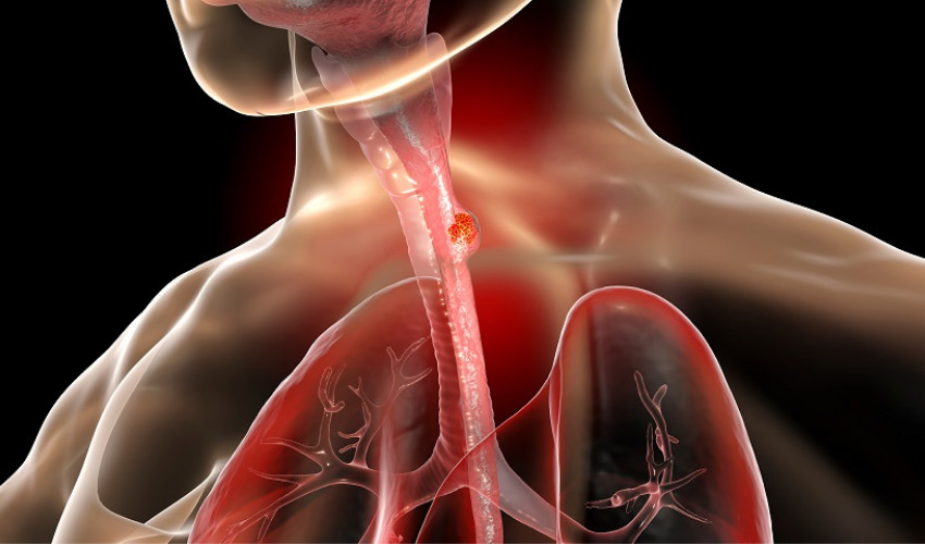 Breakthrough in Esophageal Cancer treatment thanks to 3D printed stents