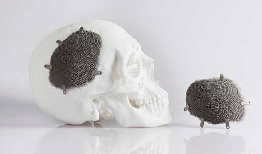 The Growing Market of 3D Printed Implants