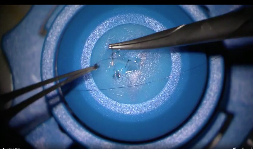 3D Printing Used For Eye Trauma Simulation Models At London Hospital