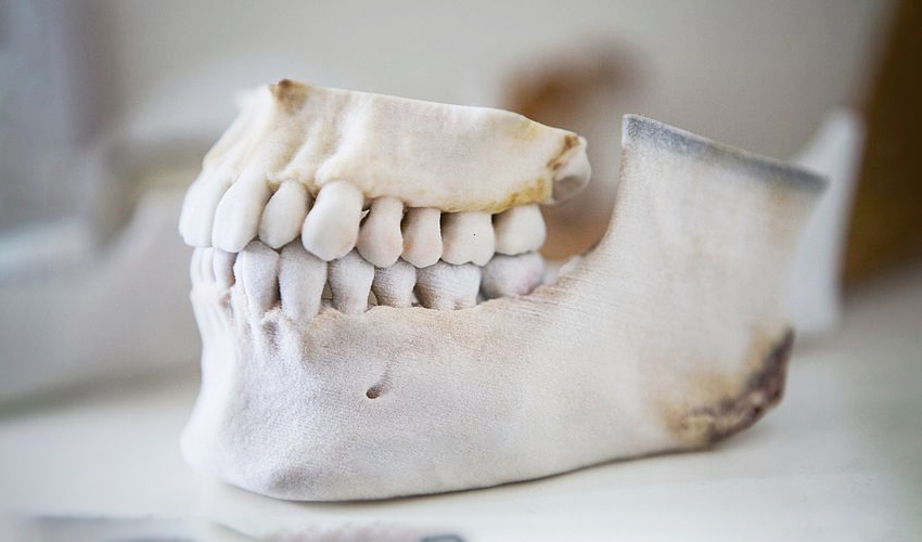 3D printing in a hospital in Mexico