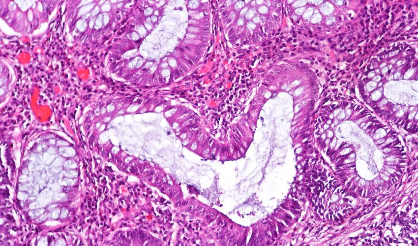 Triastek’s Latest 3D Printed Drug for Ulcerative Colitis Can Target the Colon Directly