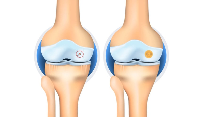 Nanochon 3D Printed Implants Repair Knee Cartilage