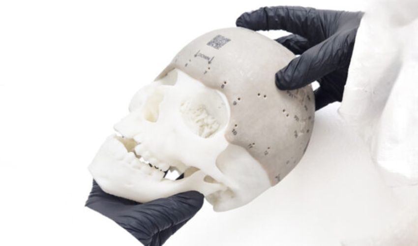 Arcomedlab Develops the Largest 3D Printed Cranial Implant in the World