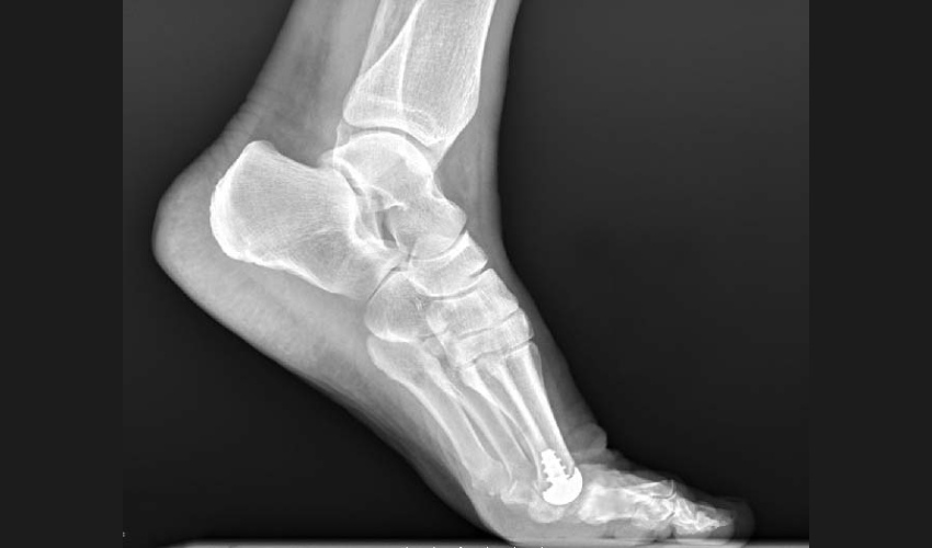 Anatomic Implants Seeks FDA Clearance for World’s First 3D Printed Toe Joint Implant