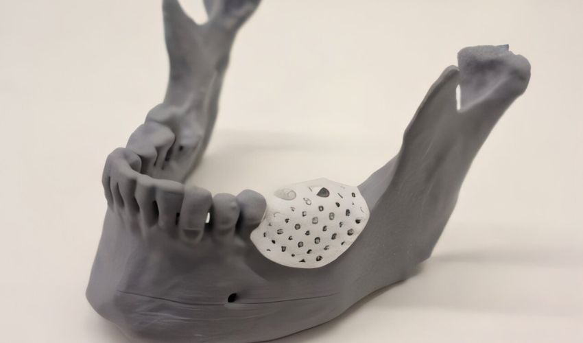 3D printed lattices for a jawbone