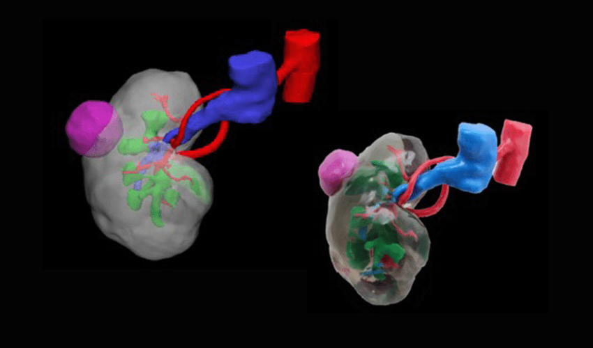 3D Printed Tumors