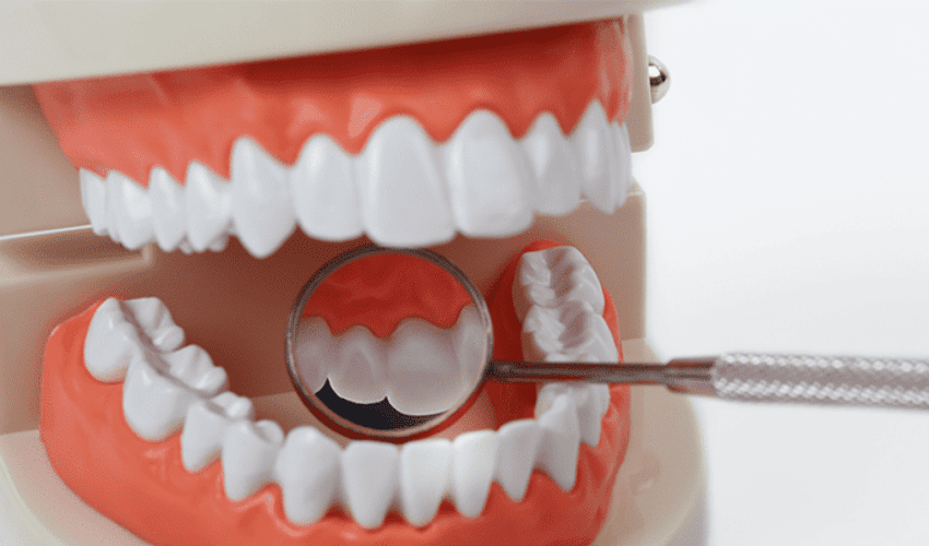 Application of the Month: SprintRay 3D Printed Teeth Restoration