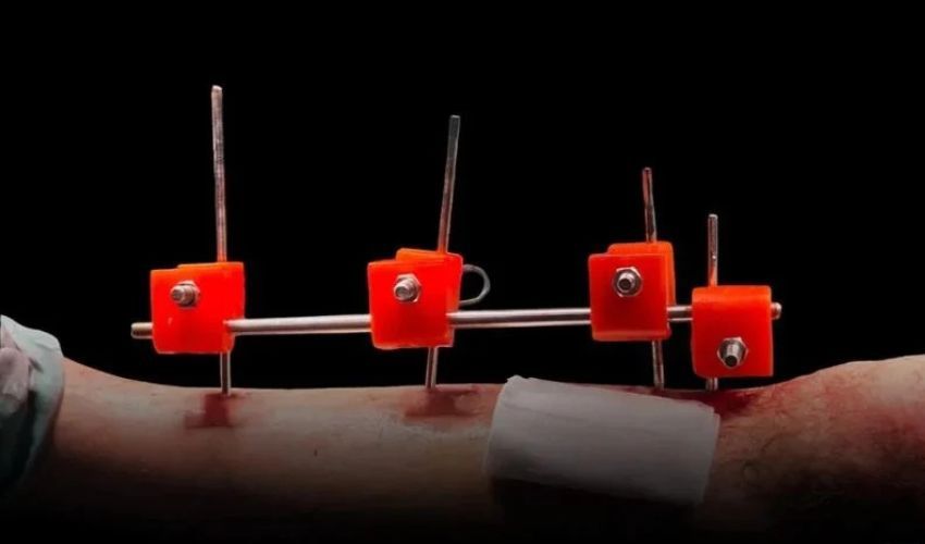 Doctors in Gaza Have Created A 3D-Printed External Fixator
