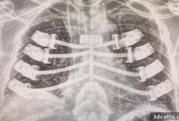 3D Printed Rib Cage Implanted in Patient