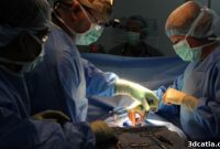 3D Printing Revolutionizes Surgical Tables