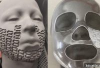 3D Printing Revolutionizes Healing for Child Burn Victims