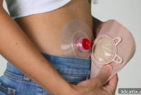 Odapt: Leak-Proof 3D Printed Ostomy Disc