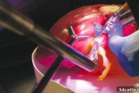 Youtuber Conducts Live Self-Surgery Using 3D Printing