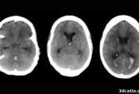 Revolutionizing Brain Aneurysm Care: The Power of 3D Printing