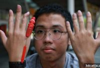 A New Hand: Singaporean Student’s 3D Printed Finger After Bike Crash