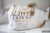 3D Printing Elevates Surgical Precision in a Mexican Hospital
