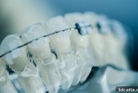 LightForce Fuels 3D Printed Braces Future with $80M