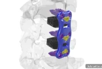 Pioneering 3D-Printed Cervical Cages Achieve Patient Success