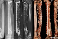 3D-Printed Scaffold Repairs Gunshot Injuries
