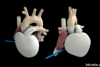 3D Printing Giants Join Forces for Artificial Hearts