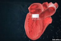 Materialise Unlocks New Cardiovascular Potential with AI Software