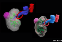 3D Printed Kidney Tumors Revolutionize Renal Cancer Research