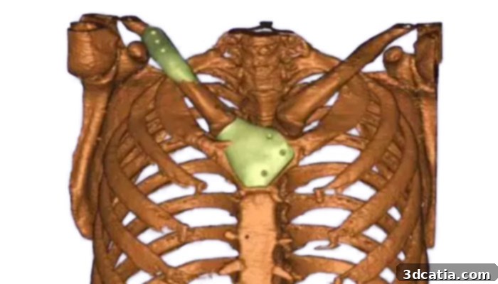 Design and Engineering of PEEK Clavicle