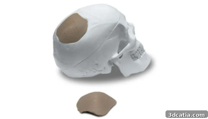 3D Printed Cranial Implant