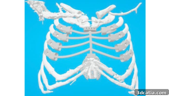 Surgical Team with 3D Printed Rib Cage