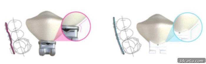 LightForce technology offers personalized orthodontic treatment based on patient morphology
