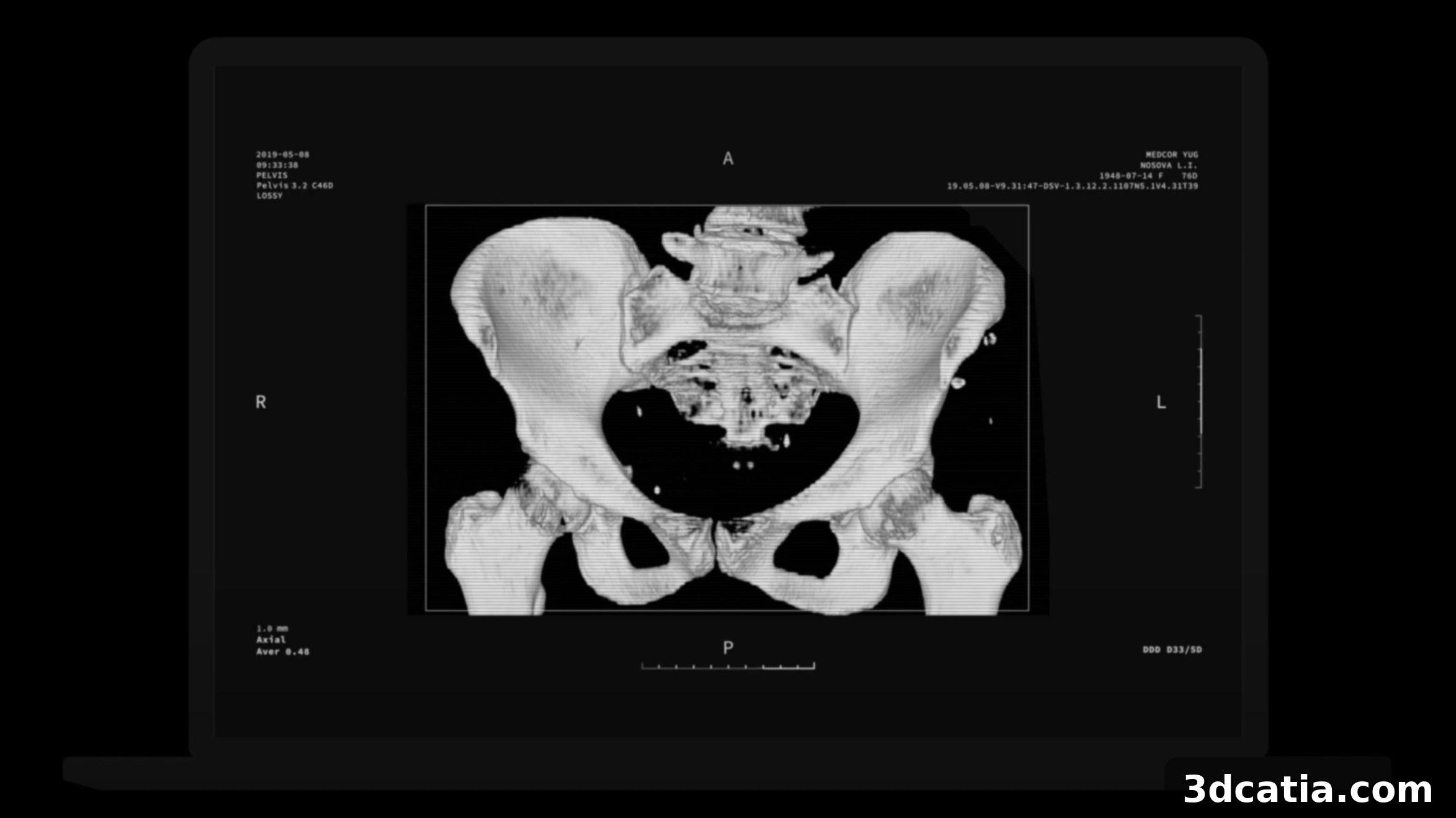 ADAM 3D Printed Bone Implants