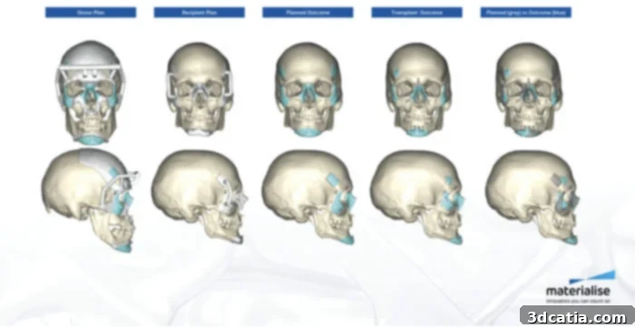 Materialise Double Transplant Surgery Planning
