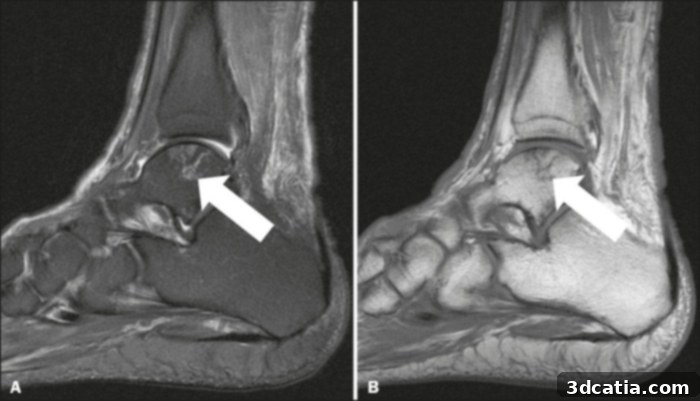 A medical imaging scan showing avascular necrosis of the talus bone in the ankle.