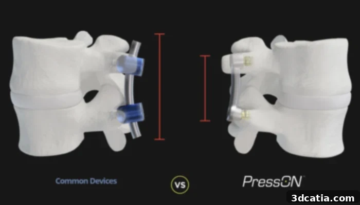 Nexus Spine's PressON