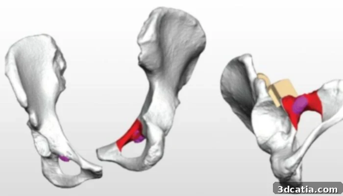 3D printed pelvic implant