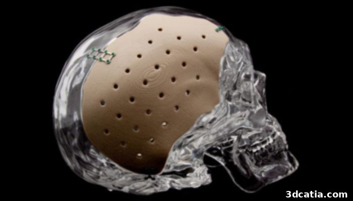 A cranial implant 3D-printed by OPM
