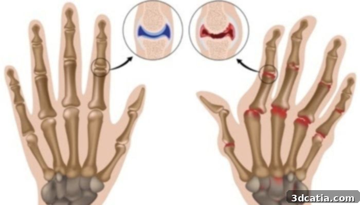 Comparison of healthy vs arthritis-ridden hands (perhaps suitable for 3D printed implants).