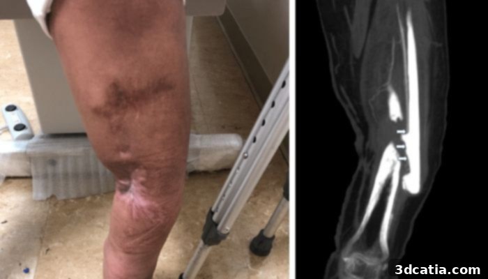 Pre-operative X-ray of patient's tibial shaft fracture, showing non-union in the right leg.