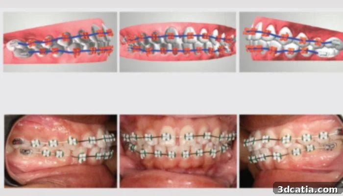 Digital workflows and AI-based software is critical to the creation of the personalized, 3D printed braces