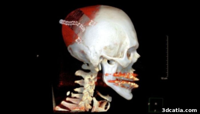 Large-scale 3D Printed Bone Implants for Skull Reconstruction