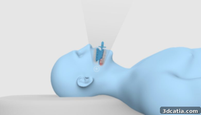 Kallisio Stentra Stent for Radiation Therapy