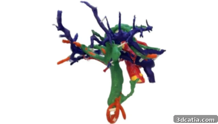 3D printed liver model aiding in tumor removal planning