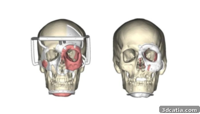 Custom surgical guides by Materialise for eye and face transplant