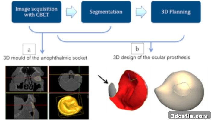 OMFS-IMPATH 3D Printed Ocular Prosthesis