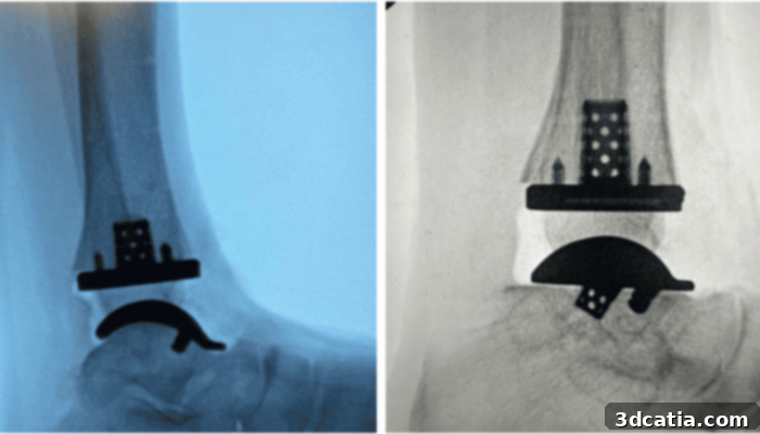 Exactech's 3D-printed tibial implants designed for total ankle replacement surgery.