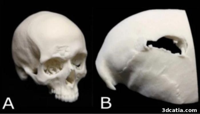 Examples of 3D-printed skull parts in fatal head injuries