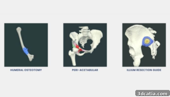 Examples of patient-specific 3D printed surgical guides designed by Insight Surgery for various anatomical applications.